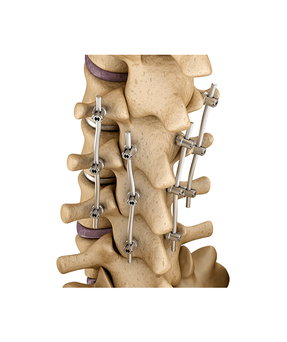2.7.1_Orthopedics_Spine-Fixation-1